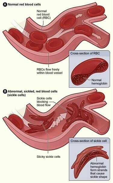 35 Best sickle cell images