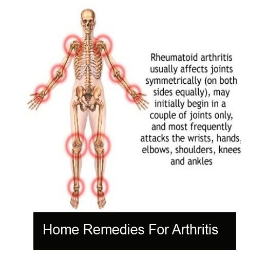 Arthritis Home Remedies ** Check out this great article.