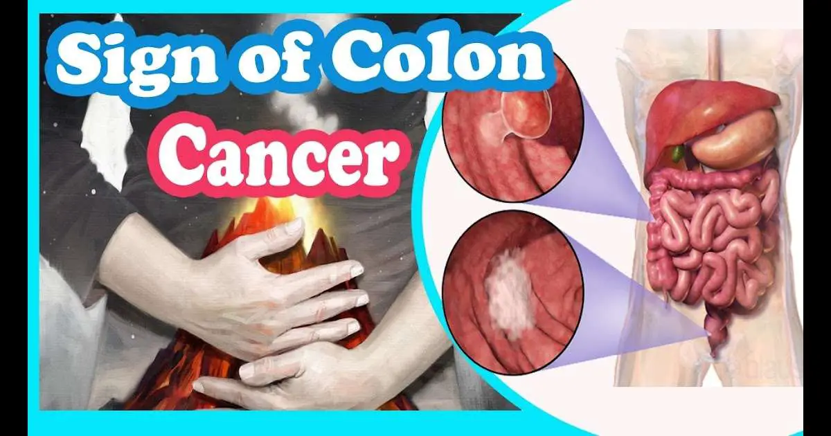 does-colon-cancer-cause-fatigue-fatiguetalk