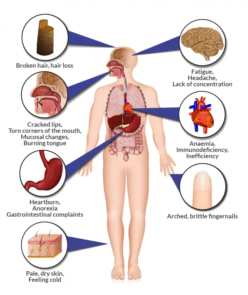 Can Lack Of Iron Cause Fatigue FatigueTalk Com   Iron Deficiency Anaemia Cfch Centre For Clinical Haematology 