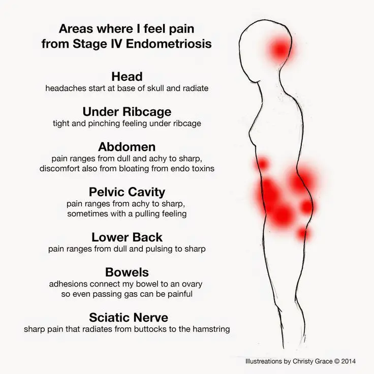 can-an-ovarian-cyst-cause-fatigue-fatiguetalk