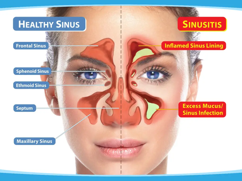 does-sinus-infection-cause-fatigue-fatiguetalk