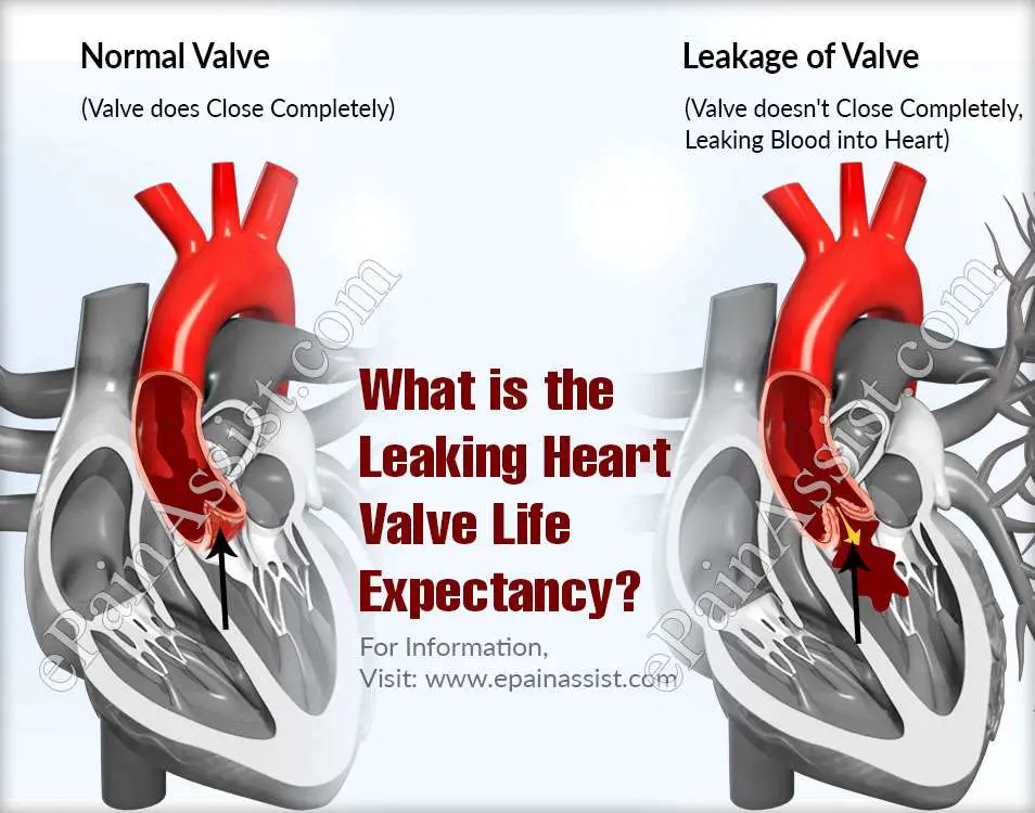 Leaky Heart Valves And Fatigue